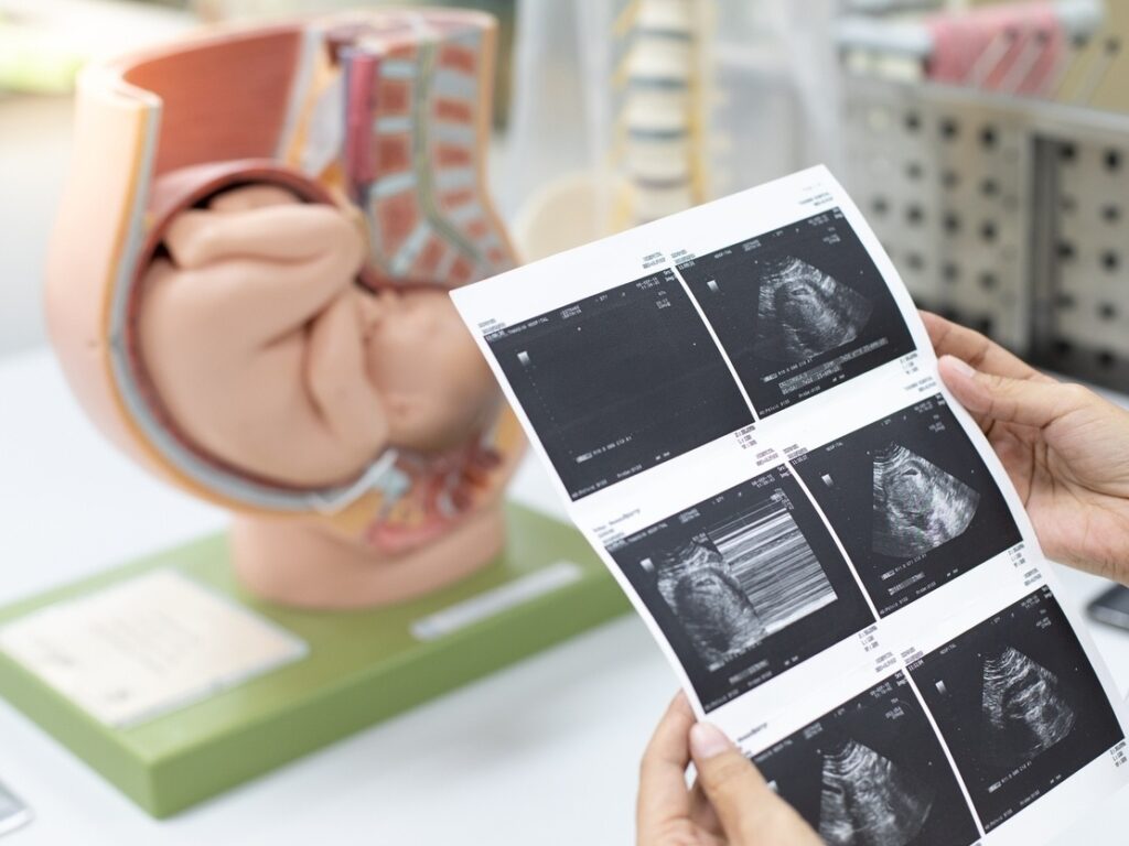 Quantos comprimidos de misoprostol para induzir o parto?